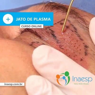 Eletrocauterização Estética – Jato de Plasma